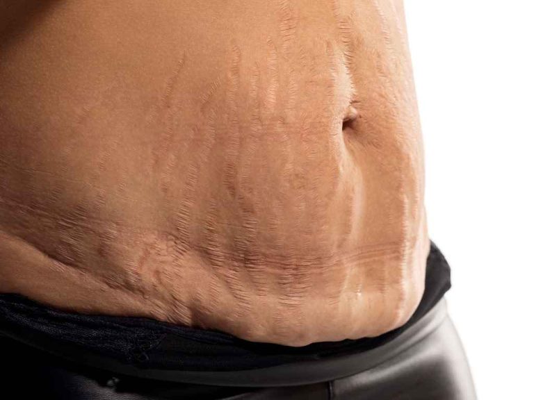 liposuction sonrası masaj ve ödem